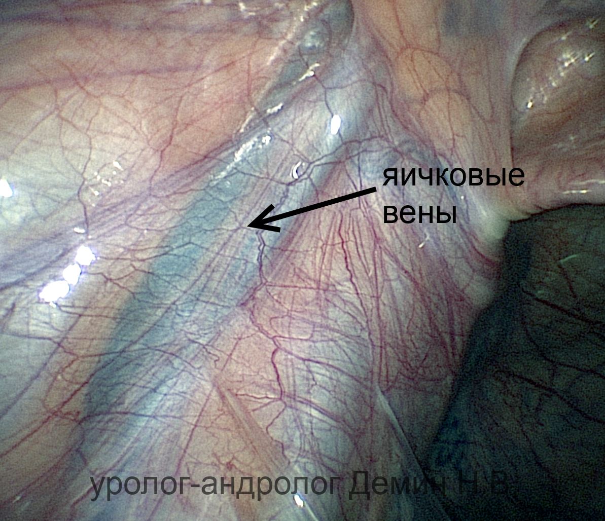 Лапароскопия, расширенные яичковые вены, фото