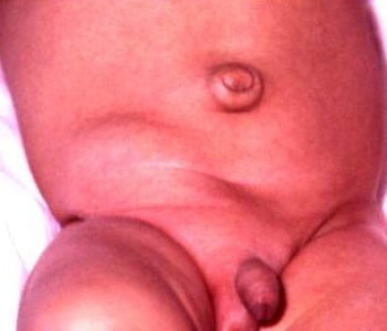 Фото паховой грыжи у младенца